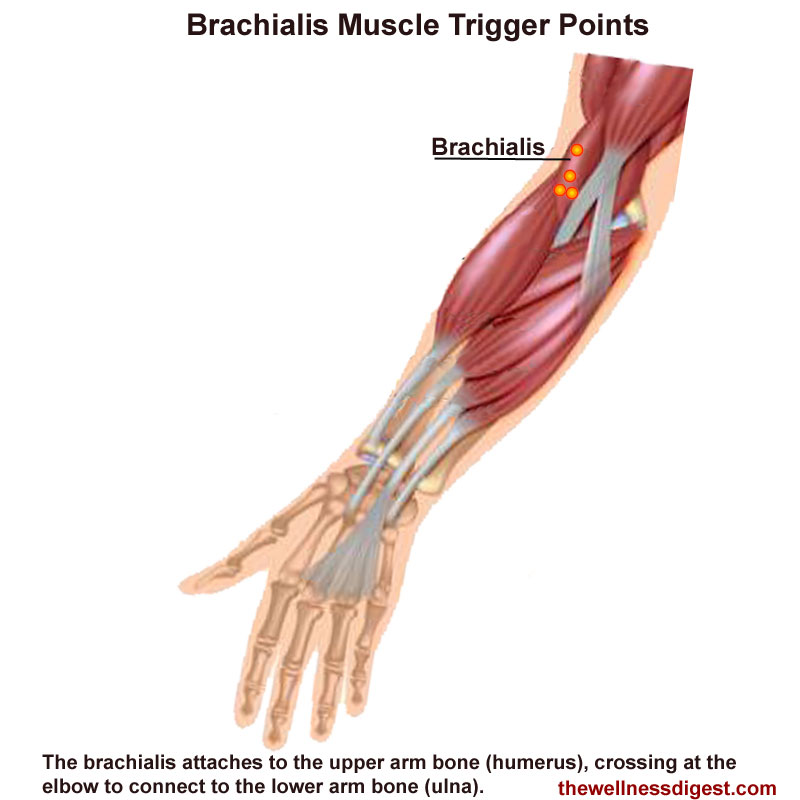 Brachialis Muscle Showing Trigger Point Location