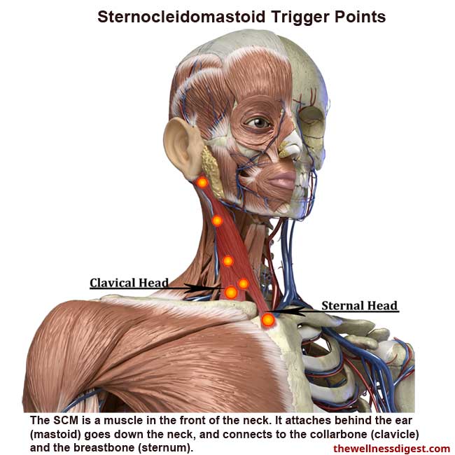 Sternocleidomastoid Muscle Showing Trigger Points Locations