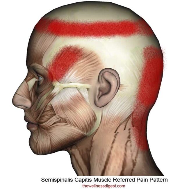 Semispinalis Capitis Referred Pain Pattern