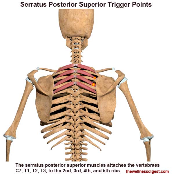 Serratus Posterior Superior Anatomy showing trigger point locations