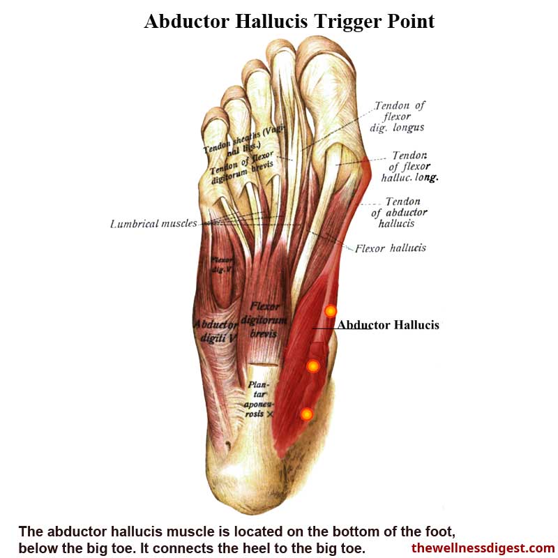 Abductor Hallucis Muscle Showing Trigger Point Locations