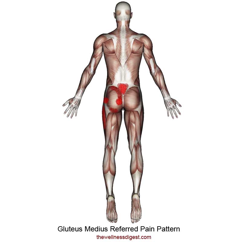 Gluteus Medius Referred Pain Pattern