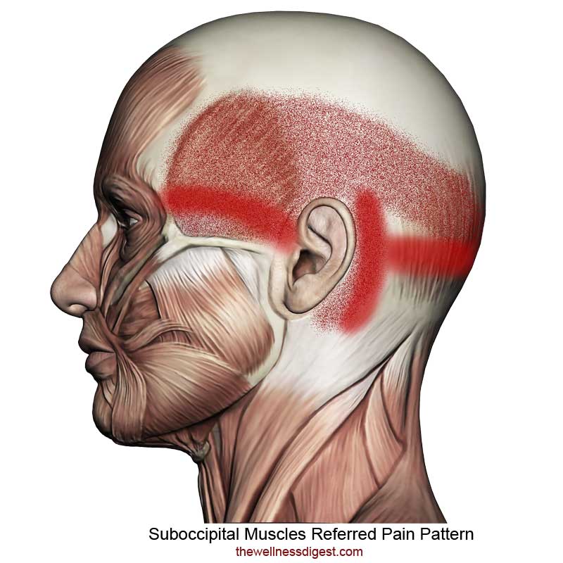 Suboccipital Muscles: Headaches, Migraines, Eye Pain - The Wellness Digest