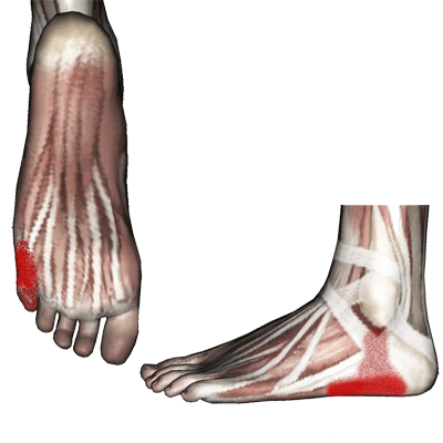 abductor-digit-minimi-pain-foot-fea
