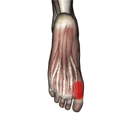 flexor-hallucis-brevis-pain-fea