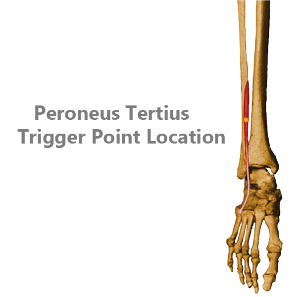 Image showing the peroneus tertius muscle trigger point location
