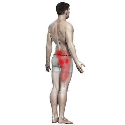 twd-glute-med-pain-400