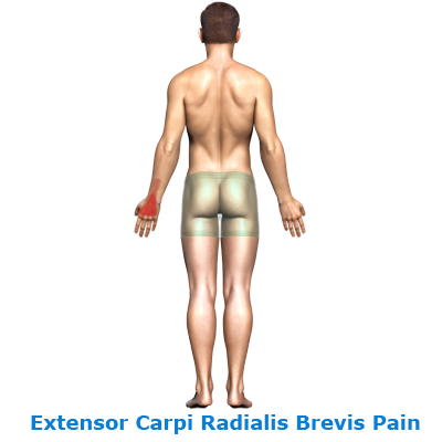 extensor-carp-radi-brevis-pain-400-link