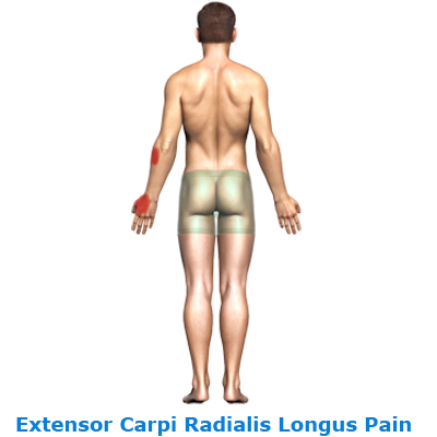 rtwd-extensor-carp-rad-longus-pain-400-link