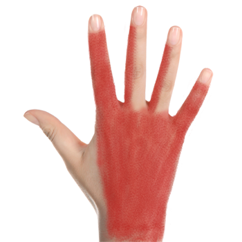 rtwd-lumbricals-hand-pain-350