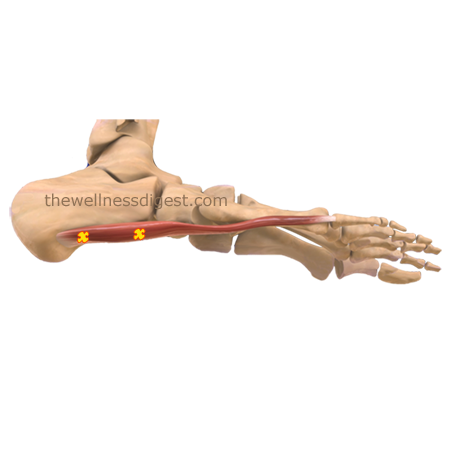 Abductor Digiti Minimi of the foot trigger points Abductor Digiti Minimi of the foot trigger points