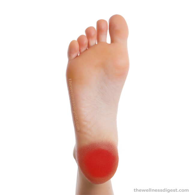 Image of human foot showing the location of quadratus plantae muscle pain.