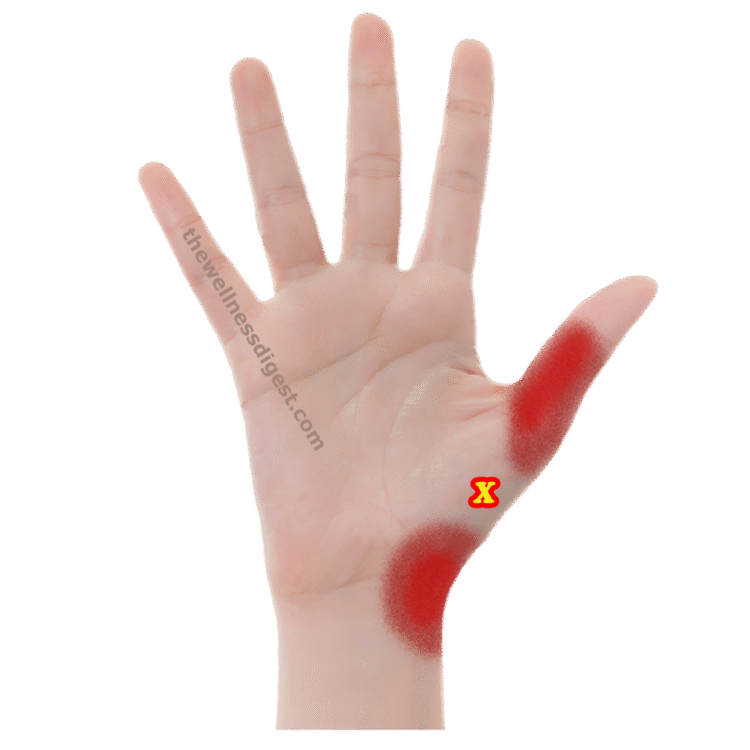Opponens Pollicis Trigger Point Image showing an opponens pollicis trigger point.
