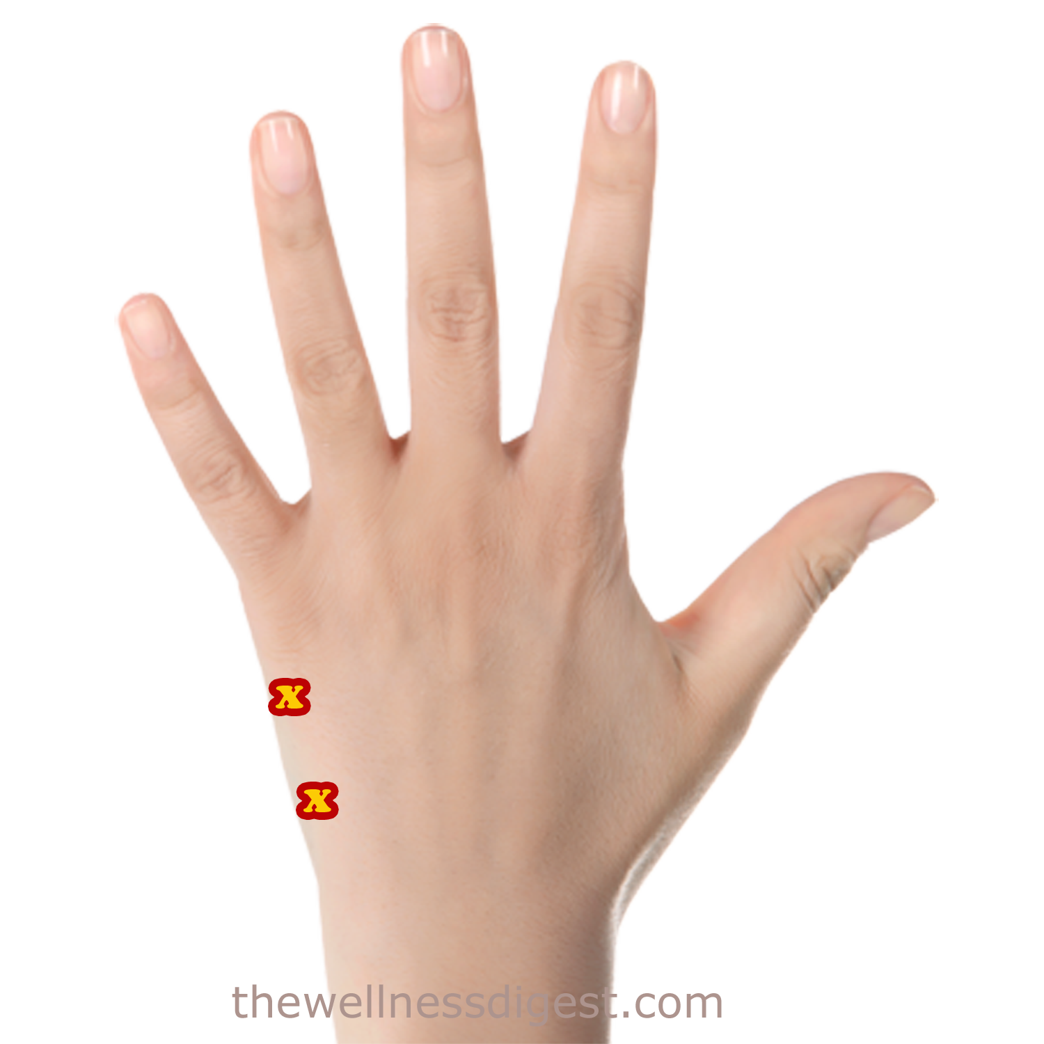 Abductor Digiti Minimi Hand Trigger Points Image showing trigger points in the abductor digiti minimi hand muscle.