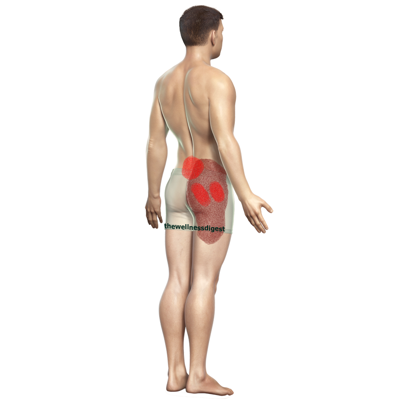 gluteus-medius-pain800