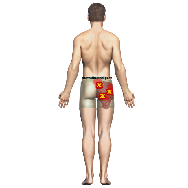 Illustration showing gluteus maximus trigger points